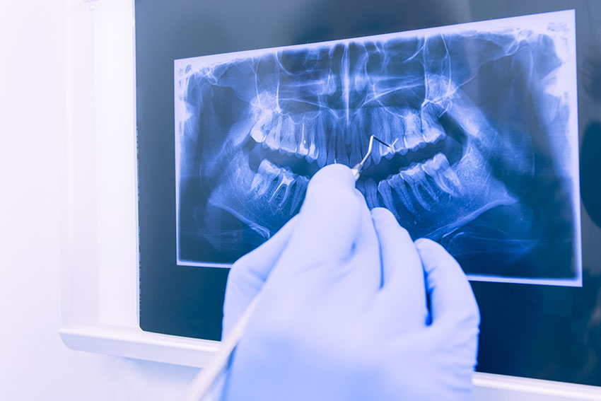 Radiología 3D para implantes